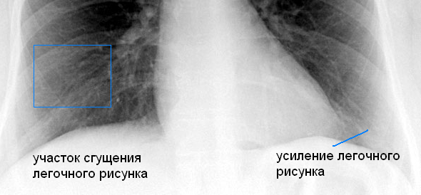 рентген легких курильщика с участками сгущения и усиления рисунка